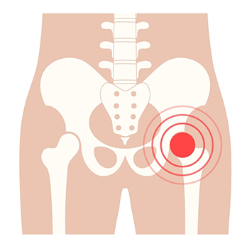 causes of hip pain in st petersburg