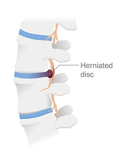 Disc Injuries | Ruptured, Herniated Disc Treatment | St. Petersburg