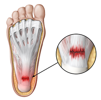 plantar fasciitis in st petersburg