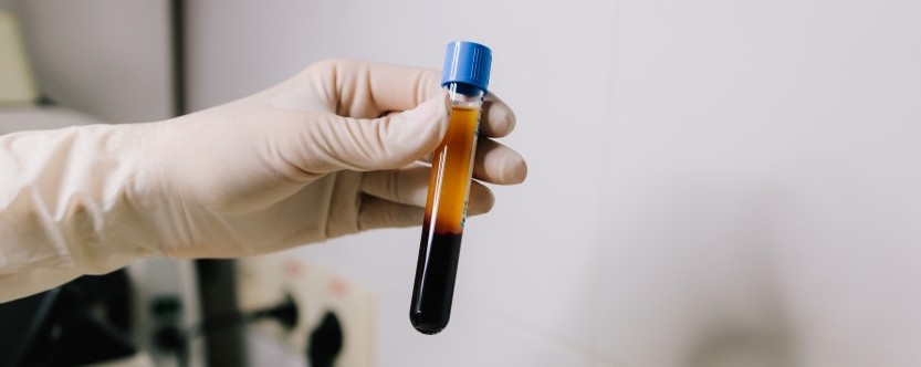 PRP therapy compared to cortisone injections for joint pain treatment