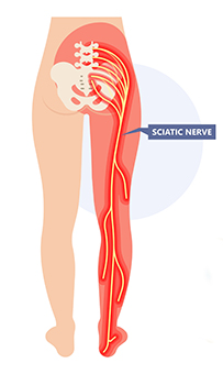 sciatica treatments in st petersburg