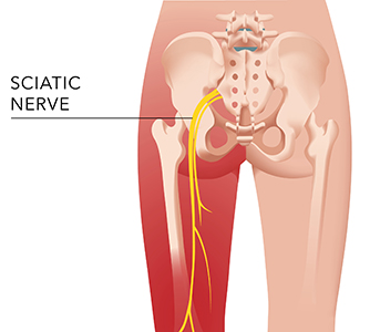 symptoms of sciatica in st petersburg