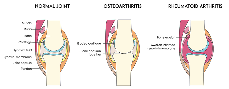 types of arthritis in st petersburg