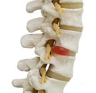 what is spinal decompression st petersburg